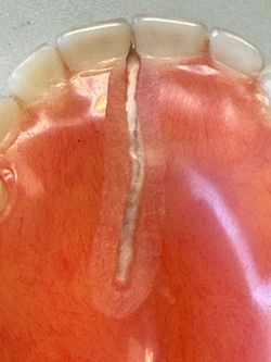 Repair dentures