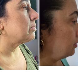Fibroblast /ojeras /tratamientos /rejuvenece