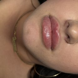 Lip Filler