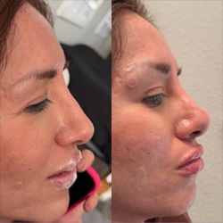 Nose filler before and after