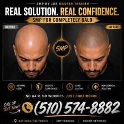 Scalp Micropigmentation (SMP) Consultation - Hair Loss Solution