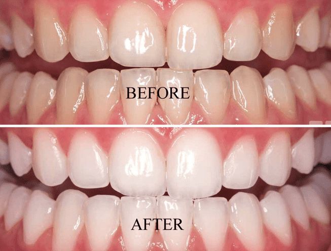Whitening Teeth 