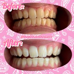 Teeth Whitening, Tooth Gems, Body Sculpting