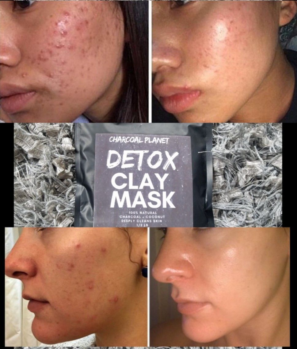 Charcoal detox mask bye acne!