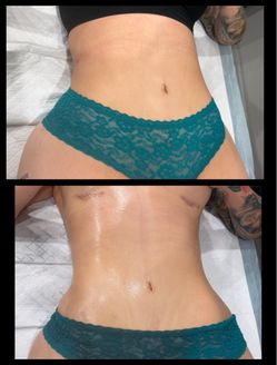 Post op massages / Body contour