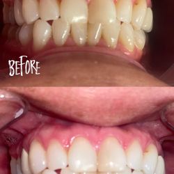 Whitening 