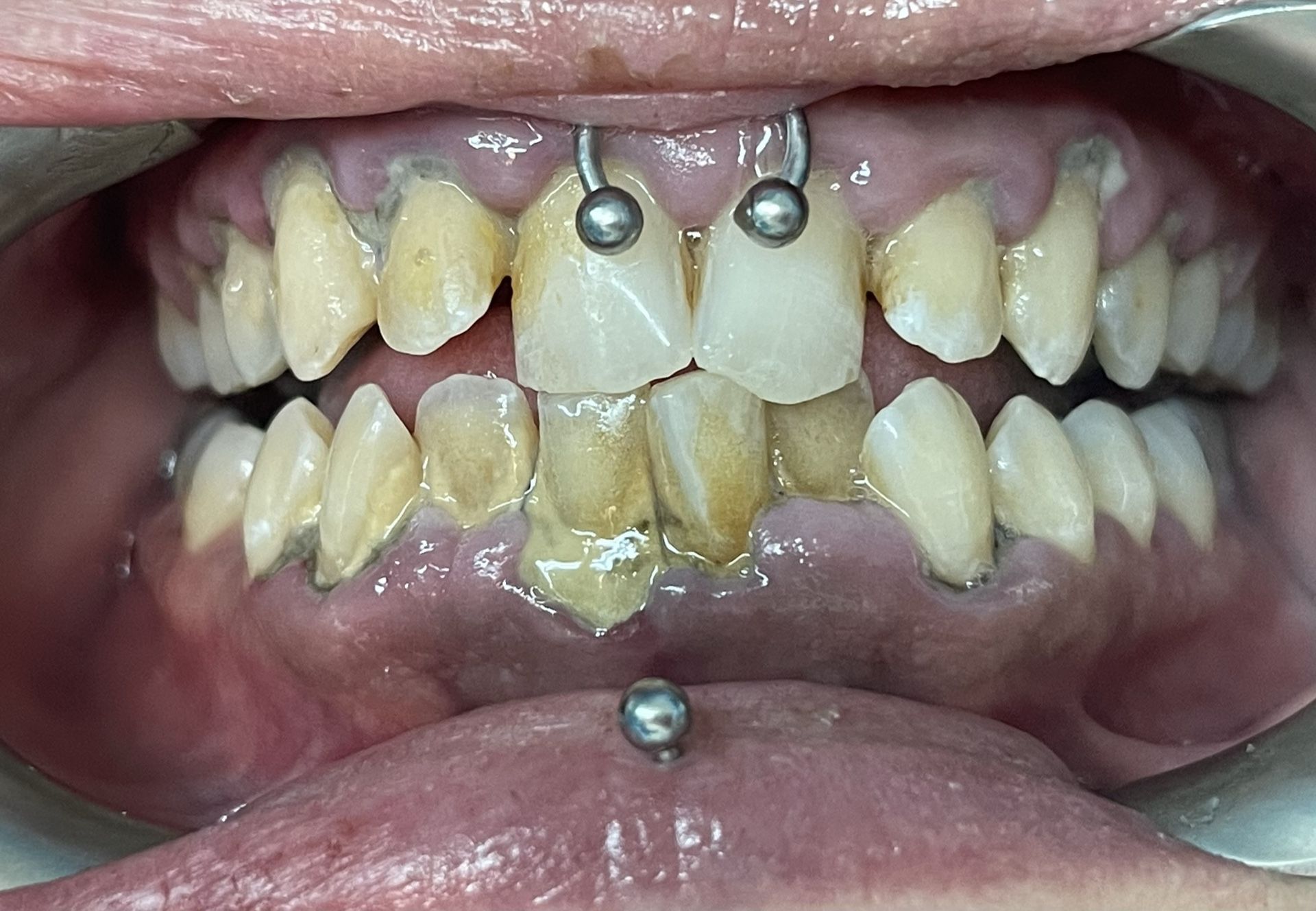Teeth Whitening And Cleanings