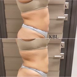 Body Contouring / Body Sculpting 