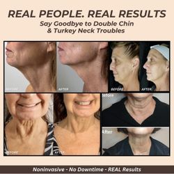 No More Turkey Neck Get Rid Of Your Loose Skin Today