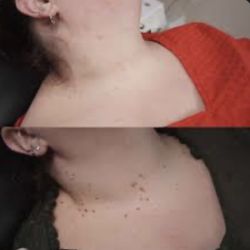 Si Hablo Español Skin Tag Removal 