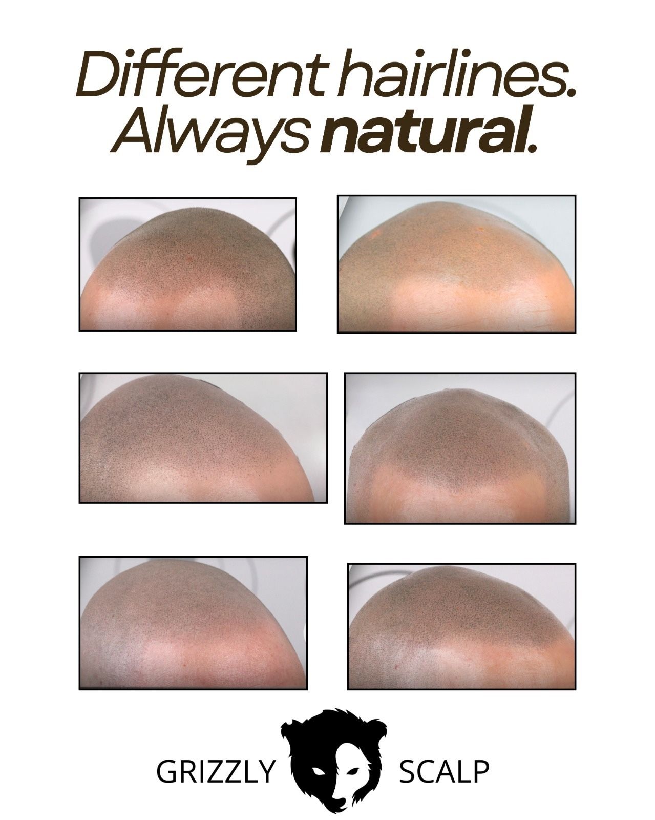 Scalp Micropigmentation In San Diego | Restore Your Hairline 