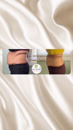 Body Sculpting Lipo360 Sculpting Rf And More 5 In One