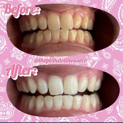 Teeth Whitening 
