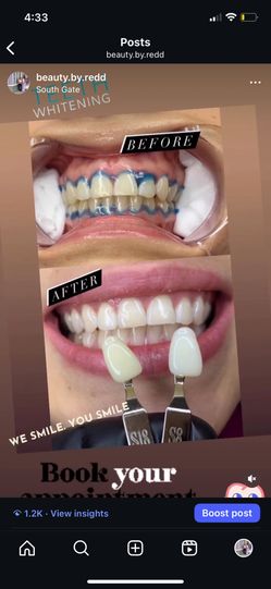 Blanqueamiento De Dientes
