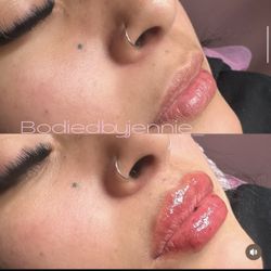 Lip Filler