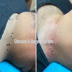 skin Tag, Moles , Wart Removal 