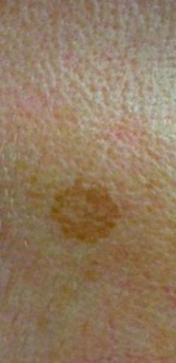 MOBILE DARK SPOT TREATMENT