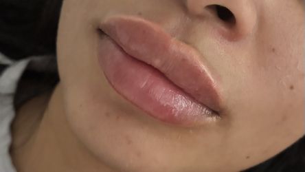 Lip Filler