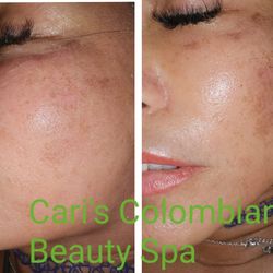 Los Mejores Faciales Y BB Glow
