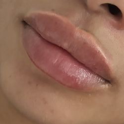 Lip Filler