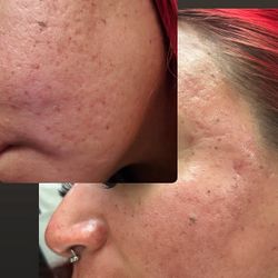 microneedling 