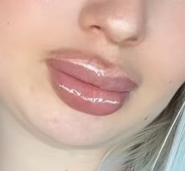 Aumento De Labios 