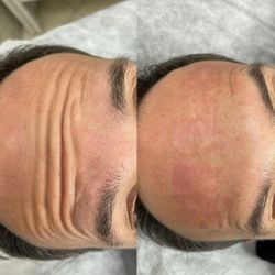 Tratamiento  de perdida de peso