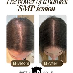 Scalp Micropigmentation For Women - Density Effect - $100 OFF 