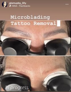 Tattoo Removal Machine