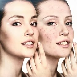 Acne  Removal quickly 