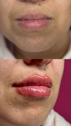 relleno de labios