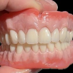 Denture Partials Stayplates