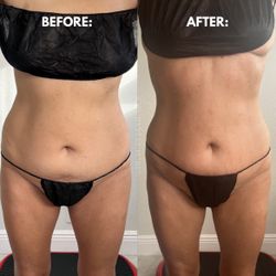 Body Contouring