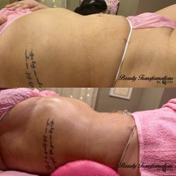 Lymphatic Drainage Massages /Post op