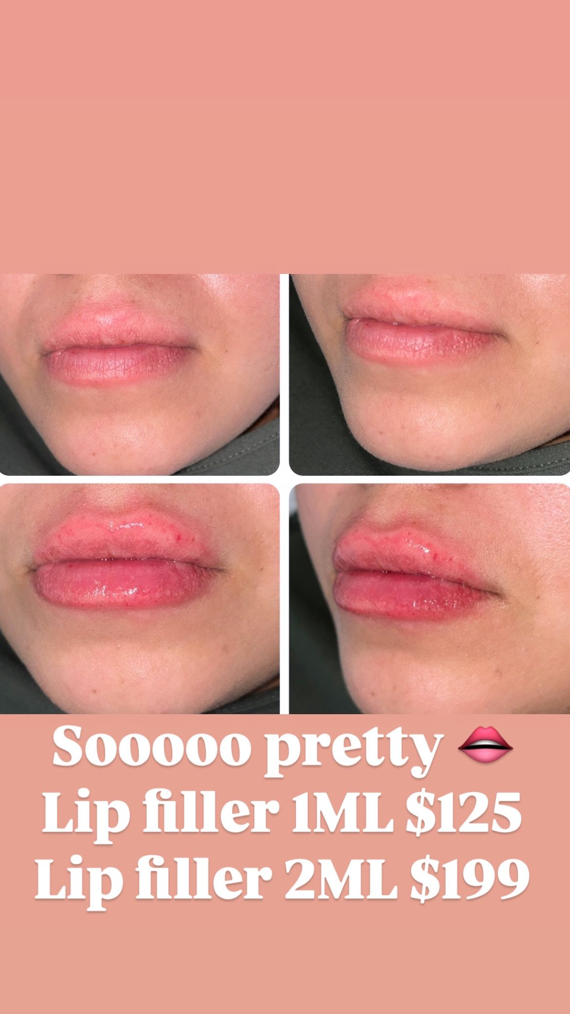 Lip Filler,All Products : American Fashion Style Bags On Sale