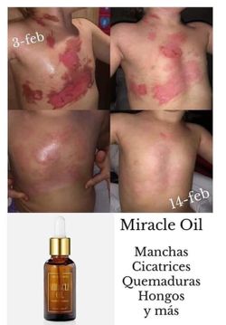 Miracle Oil Skin Healing Formula