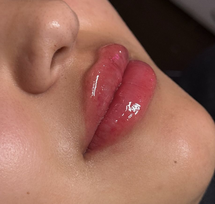 Lip Fillers