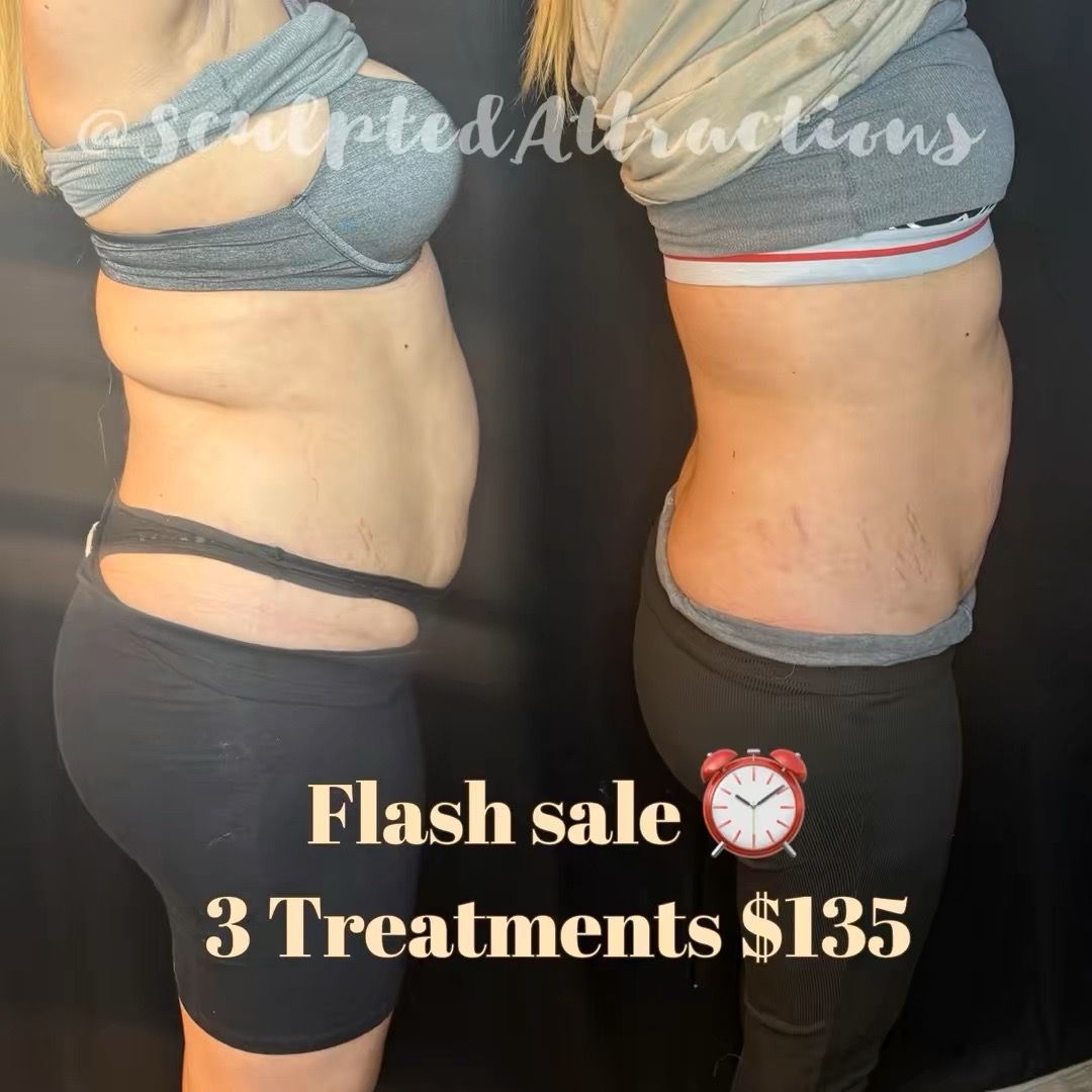 cavitation machine