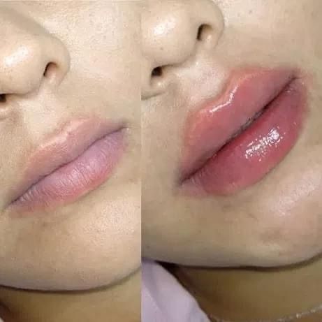 Lip Filler Hyaluronic Acid