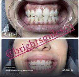 Teeth Whitening