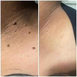 SKIN TAG/MOLE REMOVAL 