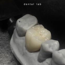 Dental Crown Veneer 