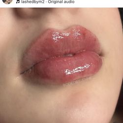 Lip Filler