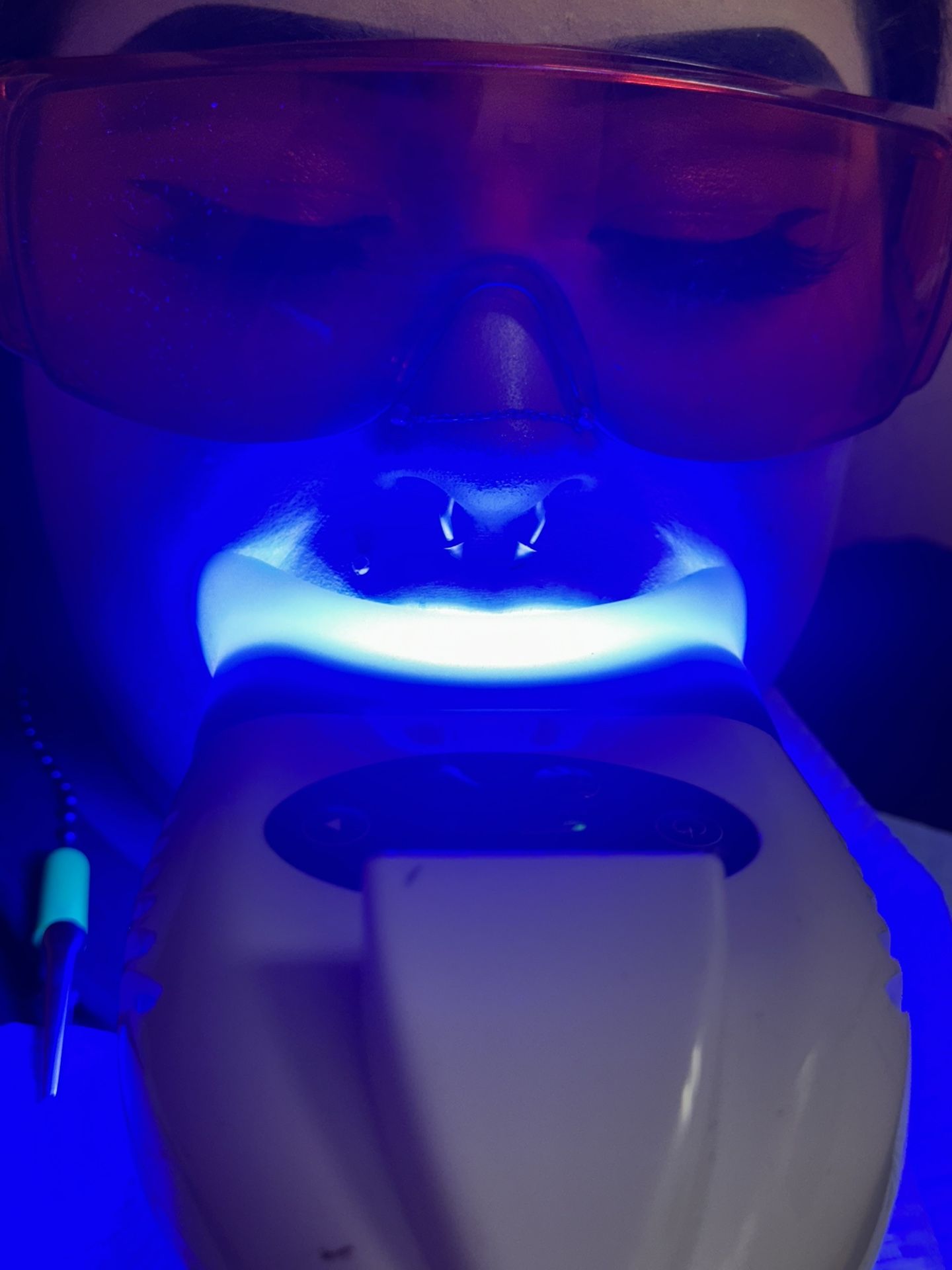 Teeth Whitening
