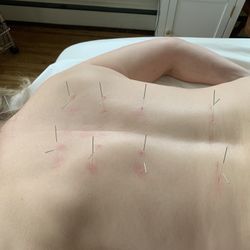 Acupuncture 