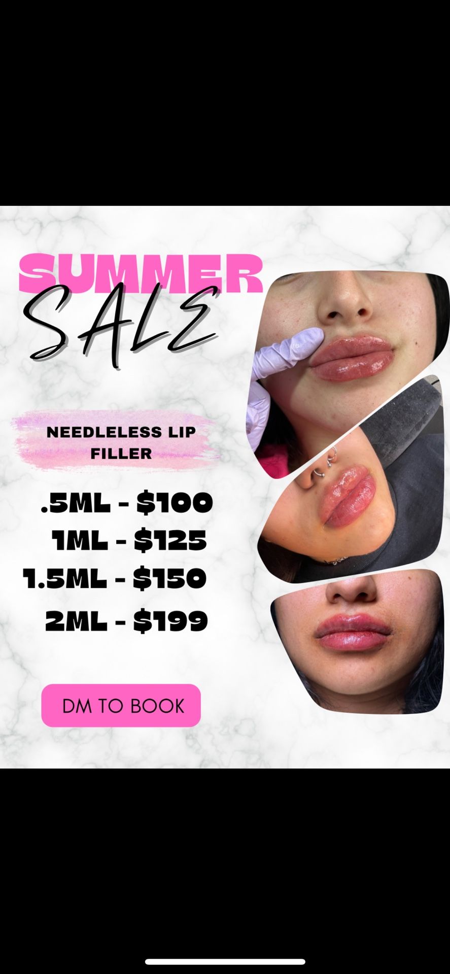 Lip Fillers/injections 