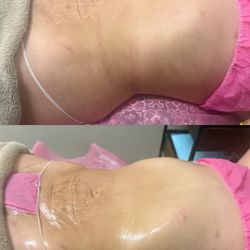 Drenaje Linfatico Radio Frecuencia 