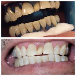 Teeth Whitening