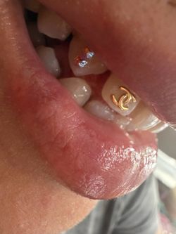 Tooth gems 💎