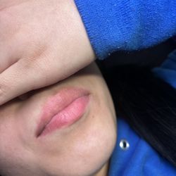 Lip Filler